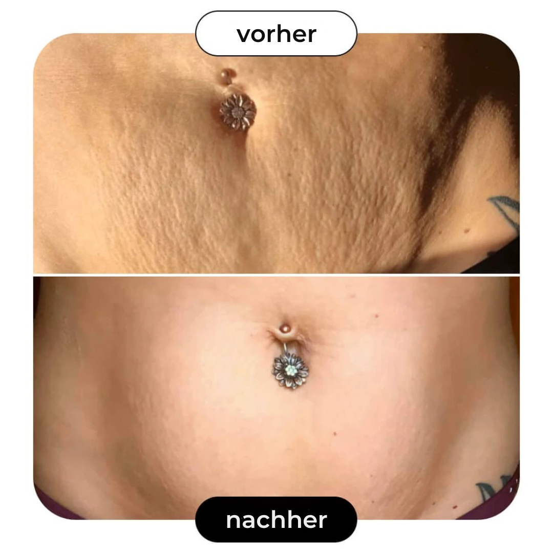 B-Flat | Anti Stretchmarks Creme