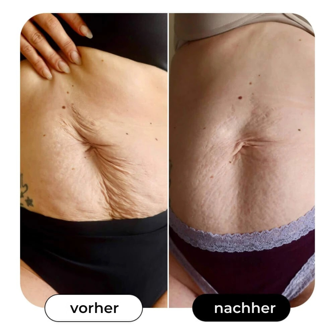 B-Flat | Anti Stretchmarks Creme