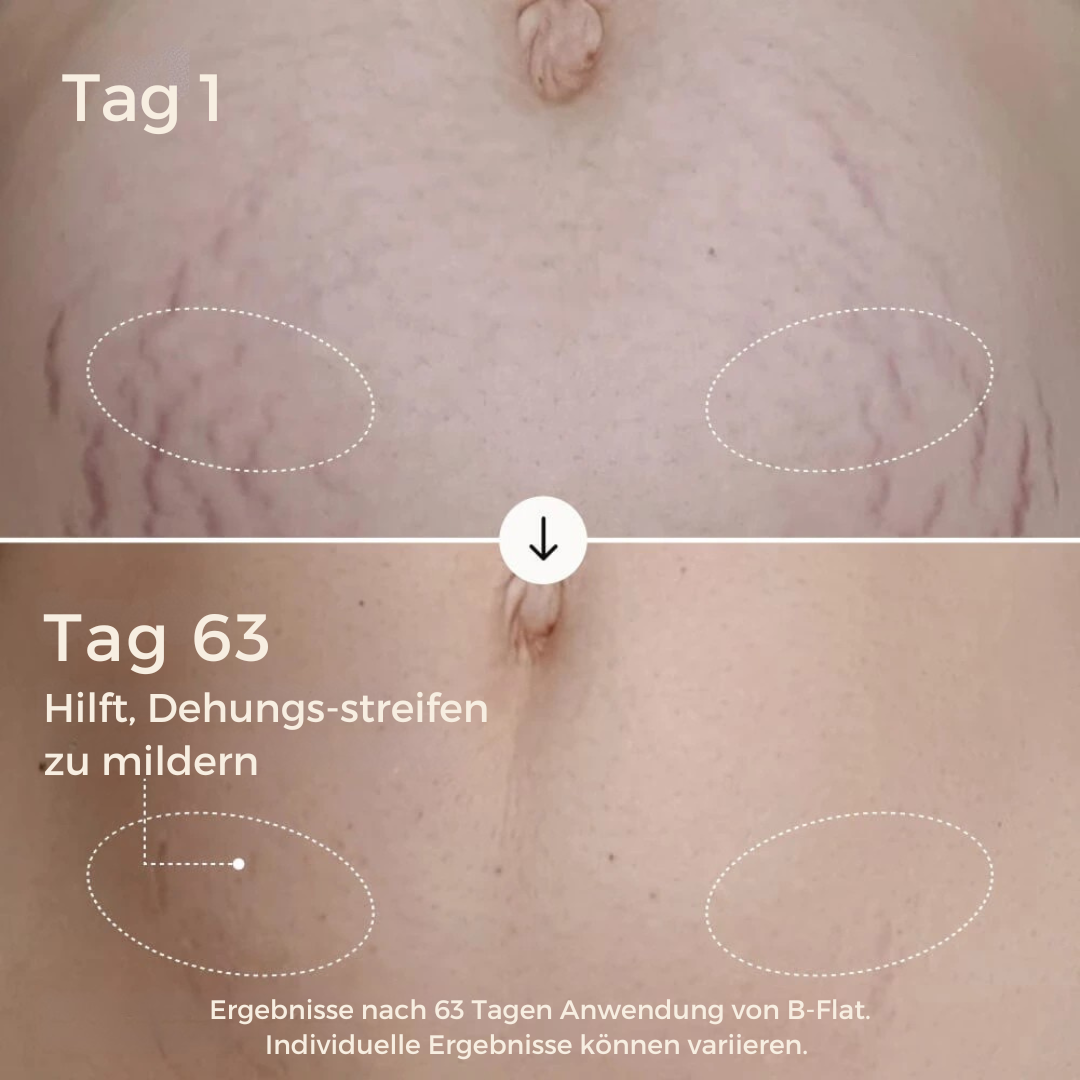 B-Flat | Anti Stretchmarks Creme